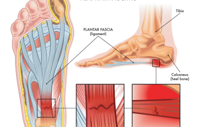 Morning Heel Pain Relief in Sioux Falls: Fix Plantar Fasciitis
