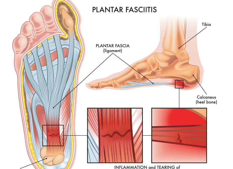 Morning Heel Pain Relief in Sioux Falls: Fix Plantar Fasciitis
